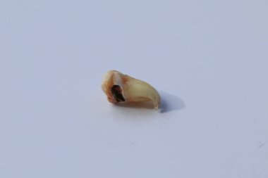 Caries tarafından çok zarar görmüş gerçek bir diş.