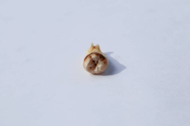 Caries tarafından çok zarar görmüş gerçek bir diş.