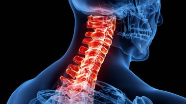 3D, acı verici bir boyun omurgasının tıbbi olarak doğru bir gösterimi.