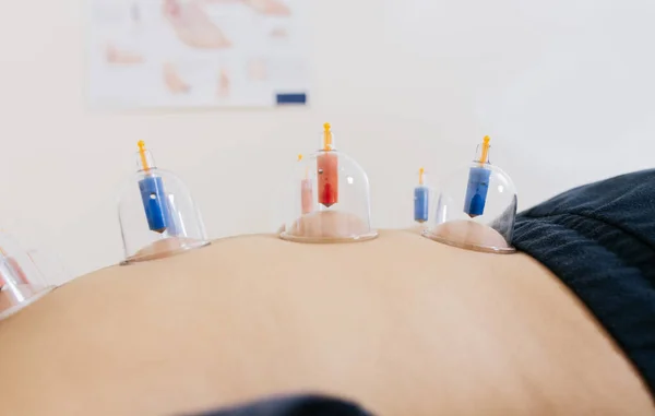 Close-up of suction cups on the patient back, Acupuncture cupping on the back of a person lying down. Patient lying down with suction cups on her back. Physiotherapy cupping on a lying patient