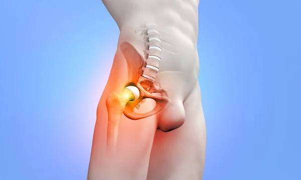 Femur hip bone with pain on human muscular male body