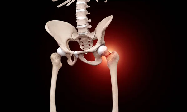 medical illustration of broken femur bone on black background