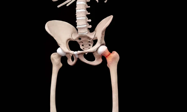 Руйнування Голови Стегнової Кістки Тазовому Погляді Скелета — стокове фото