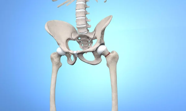 Fractured Femur Head Pelvic View Skeleton — Stock Photo, Image