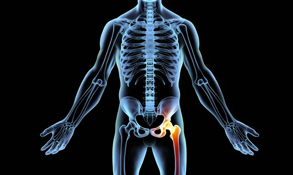 Röntgenskelett Deutet Auf Schmerzen Hüftgelenk Hin — Stockfoto