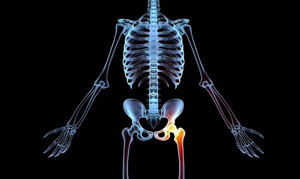 Röntgenskelett Deutet Auf Schmerzen Hüftgelenk Hin — Stockfoto