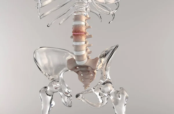 Estenosis Columna Lumbar Esqueleto Vidrio — Foto de Stock