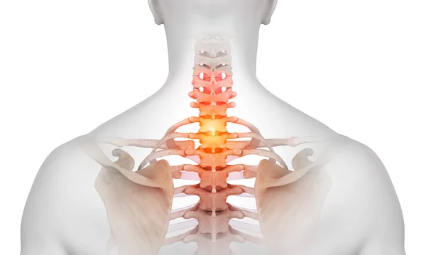 Återges Illustration Livmoderhalscancer Ryggrad Region Smärta Muskulös Skuldra Manliga Kroppen — Stockfoto