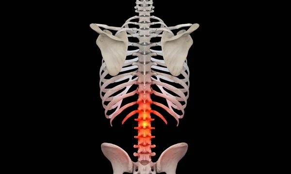 痛みを示す赤い光が付いているより低い脊椎の内腔領域 — ストック写真