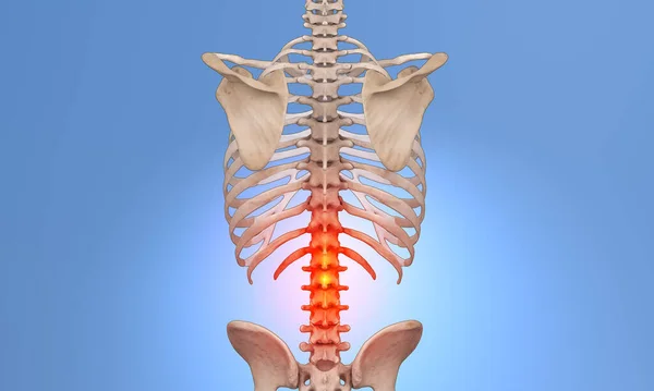 Lower Spine Lumbar Region Red Glow Indicating Pain — Stock Photo, Image