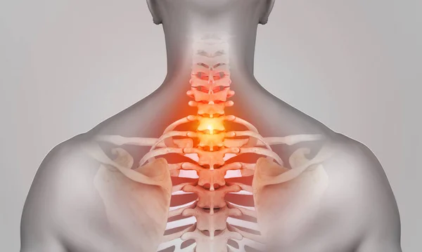 3d rendered illustration of cervical spine region in pain on muscular shoulder male body