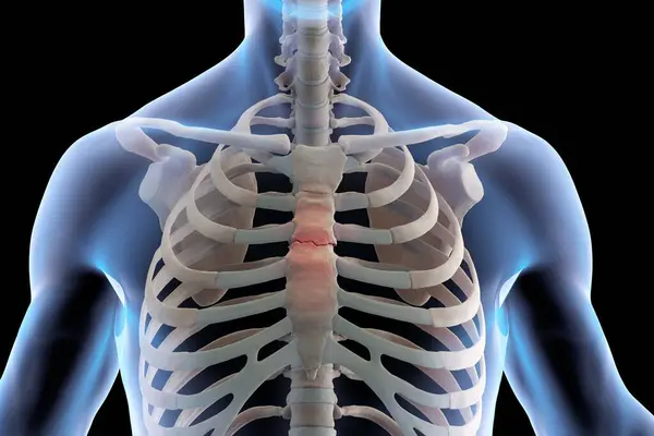 Ιατρική Απεικόνιση Σκελετού Σπασμένο Στέρνο — Φωτογραφία Αρχείου