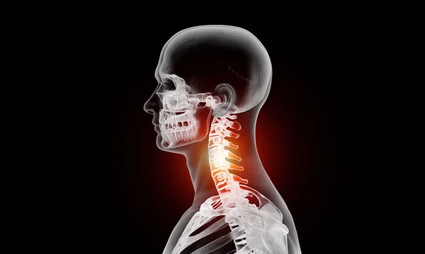 Seitenansicht Des Halswirbelsäulenschnitts Bei Wirbelsäulenverletzungen Und Schmerzen — Stockfoto