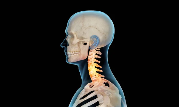 Side view of cervical section of spine injury and pain