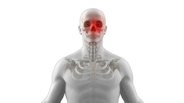 Ανθρώπινος Σκελετός Τροχιακό Κάταγμα Προσώπου — Φωτογραφία Αρχείου