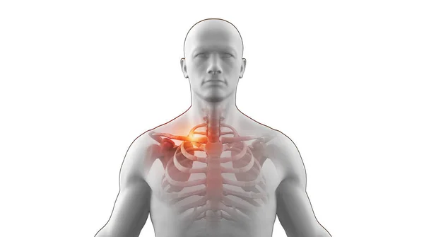 Ιατρική Απεικόνιση Του Ανθρώπινου Σκελετού Μια Σπασμένη Κλείδα — Φωτογραφία Αρχείου