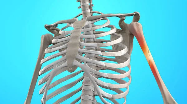 Ιατρική Απεικόνιση Του Ανθρώπινου Σκελετού Σπασμένο Βραχιόνιο Royalty Free Εικόνες Αρχείου