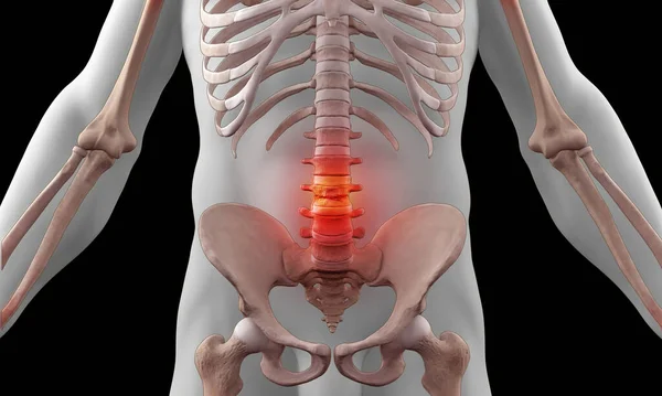 Ιατρική Απεικόνιση Του Ανθρώπινου Σκελετού Οσφυϊκή Βλάβη — Φωτογραφία Αρχείου