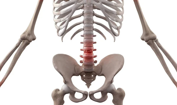 Ιατρική Απεικόνιση Του Ανθρώπινου Σκελετού Οσφυϊκή Βλάβη Royalty Free Εικόνες Αρχείου