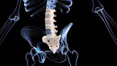 3D Medical Illustration of Orthopedic Spine Fixation Spinal Fixator Anterior Lumbar Plate clipart