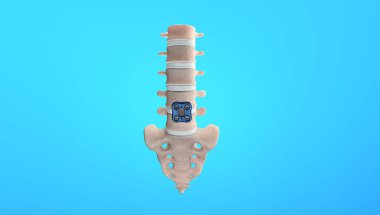 3B Ortopedik Omurga Sabitleme Omurga Sabitleyici Anterior Lumbar Plakası