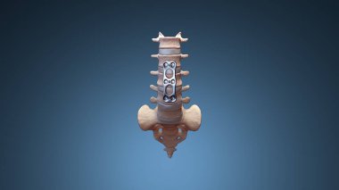 3B Ortopedik Omurga Sabitleme Omurga Sabitleyici Anterior Lumbar Plakası