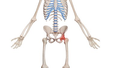 Femur ve pelvis eklemlerinde kemik iltihabı olan erkek iskeletinin tıbbi bir örneği.