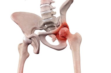 Femur ve pelvis eklemlerinde kemik iltihabı olan erkek iskeletinin tıbbi bir örneği.