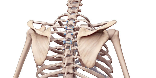 3D Медицинская иллюстрация задней части грудного сплава позвоночника с помощью винтов и стержней на скелете человека