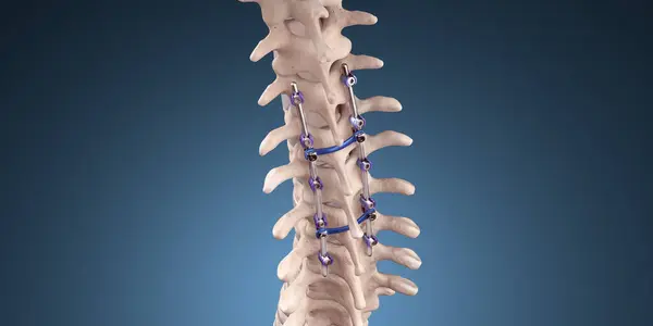 Ιατρική Απεικόνιση Του Spine Posterior Thoracic Fusion Πεντικιούρ Βίδες Και Εικόνα Αρχείου
