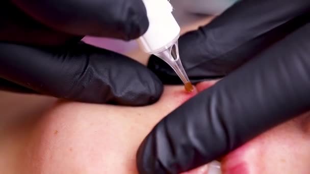 Master Pinches Corners Lips His Fingers Injects Tattoo Remover Skin — Stock Video