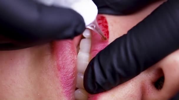 皮膚の入れ墨の除去に注入するためのマイクロ穿刺唇 高品質のフルHd映像 — ストック動画
