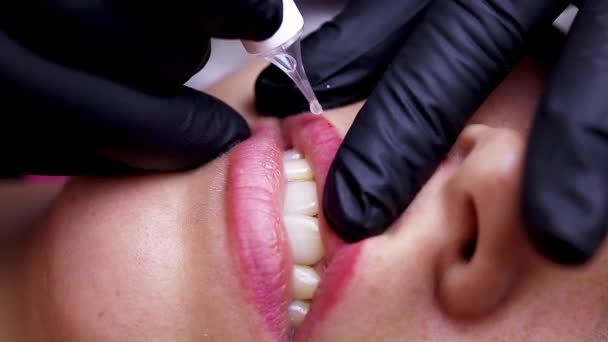 Närbild Förfarandet För Att Bort Gammal Tatuering Från Läpparna Högkvalitativ — Stockvideo