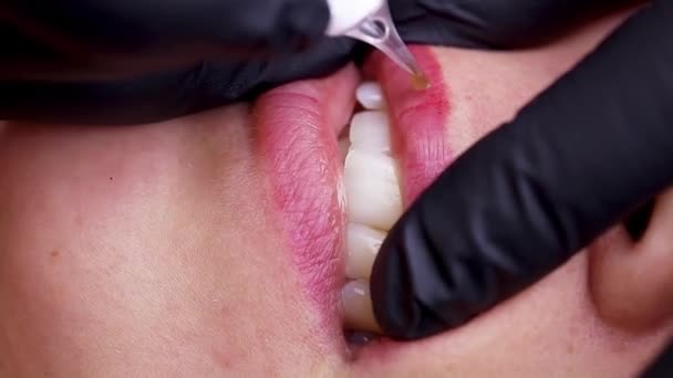 Removal Old Tattoo Upper Lip Using Micro Punctures Introduction Components — Stock Video