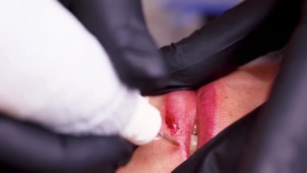 Enlèvement Vieux Tatouage Lèvre Inférieure Avec Une Machine Tatouer Décapant — Video