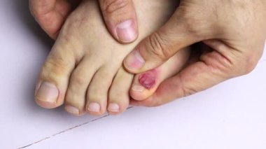 Ayak parmağında ayakkabıdan çıkan büyük bir kabarcık var.