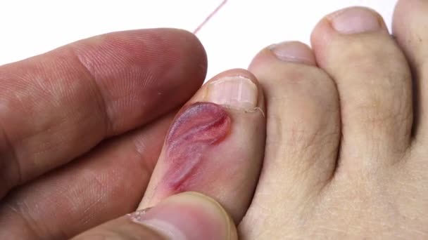Close Blister Blood Pinky Toe — Stock Video