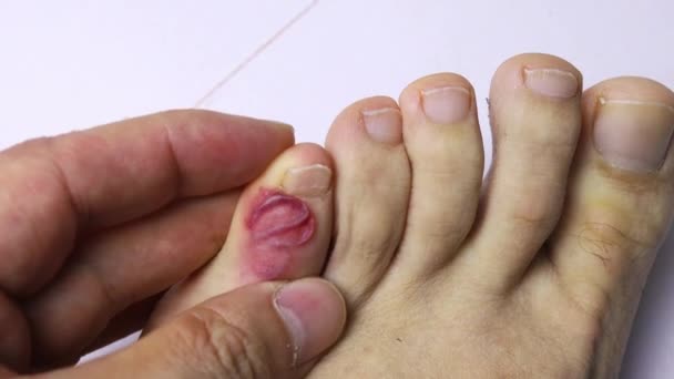 Close Blister Blood Toe — Stock Video