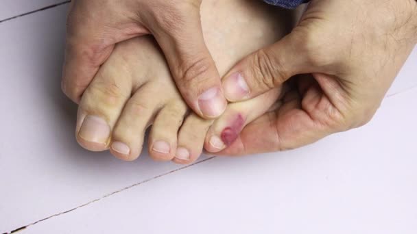 Kneads Foot Toe Blood Blister Has Formed — Stock Video