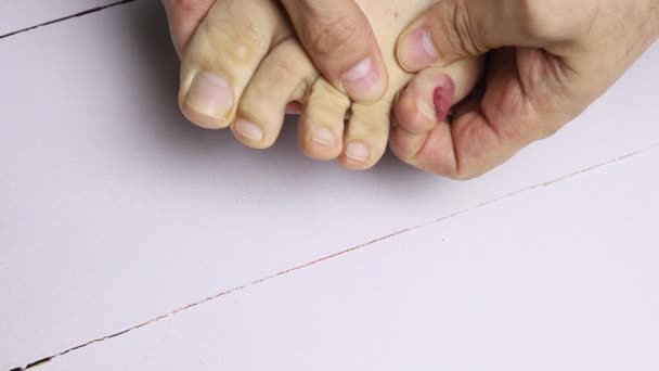Homem Toca Perna Com Dedos Amassando Uma Bolha Sangrenta — Vídeo de Stock