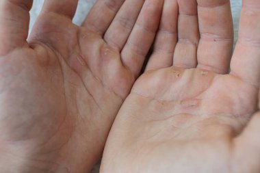 Avuçlarının nasırlı olduğu genel bir manzara. Atletizm yüzünden ellerim su topladı..