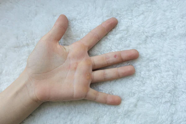 有愈伤组织的手掌作为一名运动员的辛苦工作使双手发泡 — 图库照片