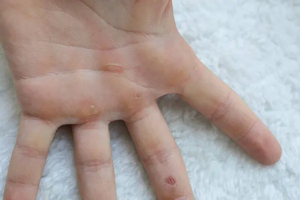 A close-up of the calluses on the fingers of the palm of the hand. Hands blistered from the hard work of being an athlete.