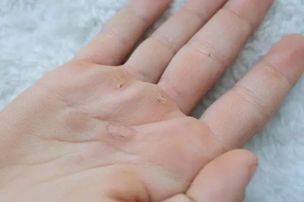 A close-up of the palm of his hand, showing the calluses. Hands blistered from the hard work of being an athlete.