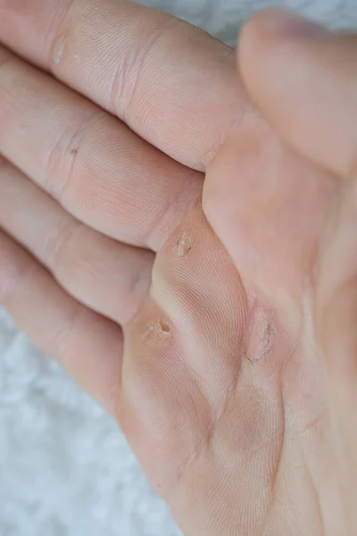 A close-up of the palm of his hand, showing the calluses. Hands blistered from the hard work of being an athlete.