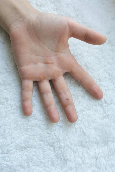 Een Hand Met Eelt Handpalmen Handen Blaren Van Het Harde — Stockfoto