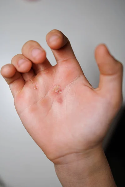 The palm of an athlete\'s hand after training A lacerated callus on the palm of my hand.