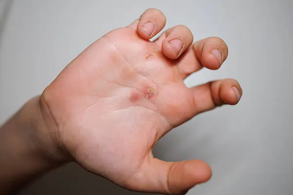 The palm of an athlete\'s hand after training A lacerated callus on the palm of my hand.