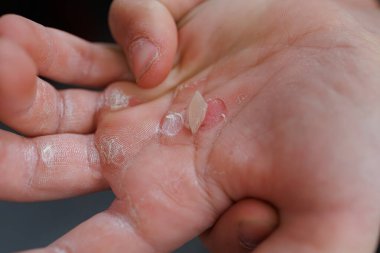 Avucunun içine yapışmış, derisi yırtılmış, avucumun içinde yırtılmış bir nasır..