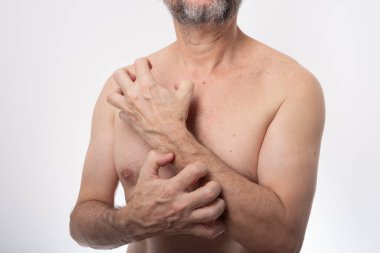 Üstsüz, kollarını kaşıyan bir adam. Alerjik reaksiyon. Deri hastalığı. Dermatoloji. Beyaz arkaplanda izole.